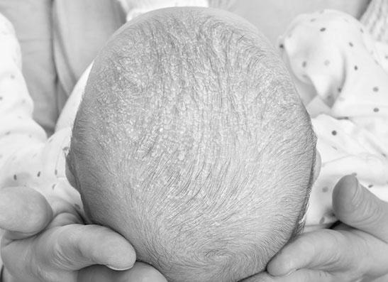 What is Cradle Cap and How to Get Rid of it image 0