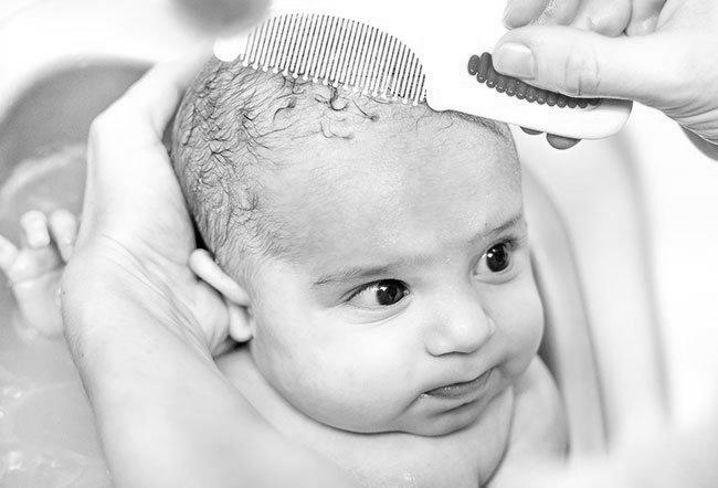 What is Cradle Cap and How to Get Rid of it image 1